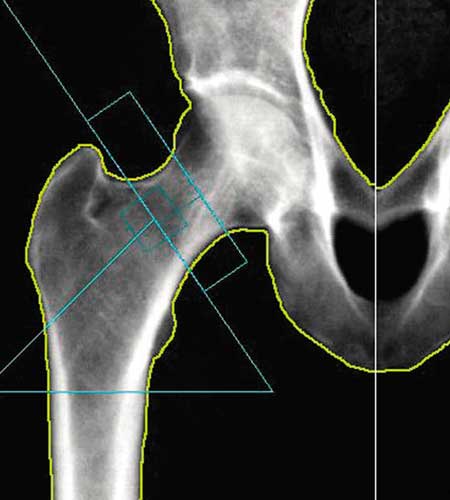 Image from a DEXA bone density scan of a patient's hip, similar to the scans provided by Dr. Reuben Elovitz and the team at Private Health Dallas as part of the concierge care and annual physical exam.