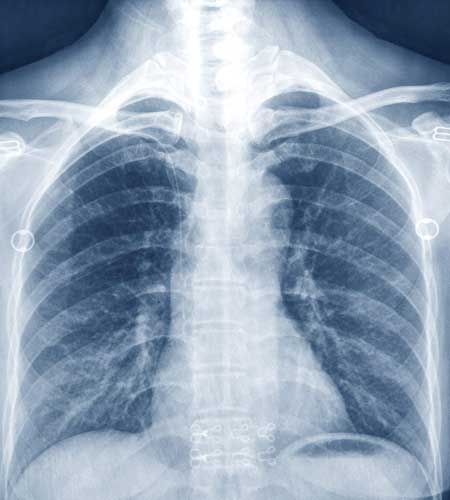 Xray image of a person, similar to the imaging provided by Southwest Diagnostic and Imaging for Dr. Reuben Elovitz and Private Health Dallas.